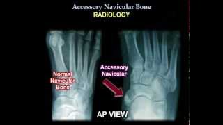 Accessory Navicular Bone  Everything You Need To Know  Dr Nabil Ebraheim [upl. by Neelyhtak]