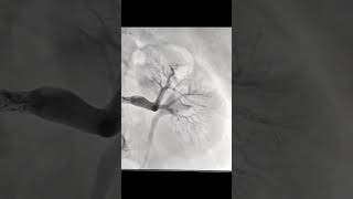 Left Renal Angioplasty in ISR ie stent in stent oct guided [upl. by Iznik]