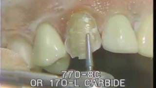 Maxillary Cuspid Preparation for a Porcelain Fused to Gold Crown [upl. by Eillek647]