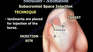 Shoulder bursitis Tendonitis Injection Animation  Everything You Need To Know  Dr Nabil Ebraheim [upl. by Aioj]