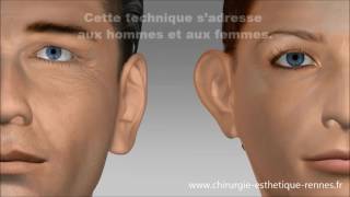 Technique earfold Oreilles décollées par le Dr Delliere [upl. by Kariv]