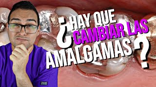 RESINA 💎 Vs AMALGAMA DENTAL🌡️ ¿Debo CAMBIAR 🤔 PREGUNTAS Y RESPUESTAS [upl. by Pulchi]