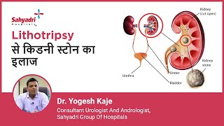 Lithotripsy से किडनी स्टोन का इलाज  Lithotripsy for Kidney Stones  Dr Yogesh Kaje Sahyadri [upl. by Aieki]