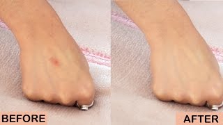 निशान हटाने का आसान उपाय How to Remove Scars 100 Effective [upl. by Machos]