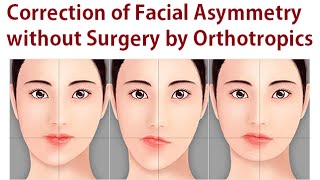 Correction of Facial Asymmetry Without Oral Surgery Using Orthotropics Method By Dr Mike Mew [upl. by Akemot]