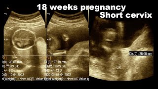 18 weeks pregnancy  short cervix  28 cm Long  Pregnancy Profile  Amader hospital [upl. by Siraj]