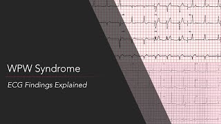 WolffParkinsonWhite WPW Syndrome ECG [upl. by Eynaffit297]