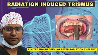 Dr Rudra Mohan  RADIATION INDUCED TRISMUS Limited Mouth Opening after Radiation Therapy for Cancer [upl. by Aciras16]