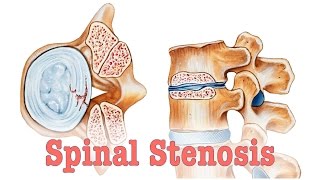 Spinal Stenosis  Surgery vs Chiropractic Care [upl. by Bakemeier]