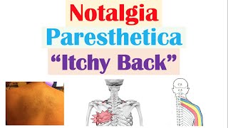 Notalgia Paresthetica “Itchy Back”  Causes Risk Factors Symptoms Diagnosis Treatment [upl. by Culley]