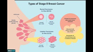 Treatment of Ductal Carcinoma in Situ [upl. by Fennessy765]