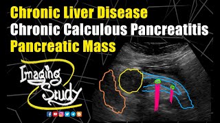 Chronic Liver Disease  Chronic Calculous Pancreatitis  Pancreatic Mass  Ultrasound  Case 189 [upl. by Sloane797]