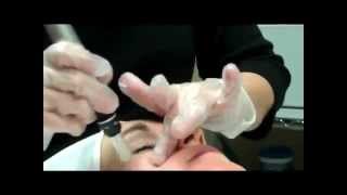 Dermapen Scottsdale AZ Practioner showing Micro Needling SkinPen Thearpy [upl. by Mel199]