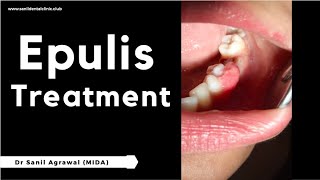 Gingival Enlargement  Epulis  Treatment  Dr Sanil Agrawal [upl. by Irep]