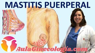 MASTITIS PUERPERAL SÍNTOMAS DIAGNÓSTICO TRATAMIENTO LACTANCIA  Ginecología y Obstetricia [upl. by Nurse]