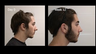 Minoxidil Beard Growth  3 Month Transformation  Timelapse BEFORE and AFTER [upl. by Merc]