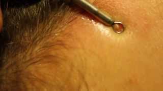 Blackhead extraction  forehead zit [upl. by Say]