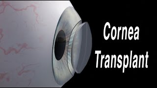 Cornea Transplant Penetrating Keratoplasty [upl. by Bannerman442]