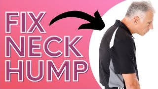 How You Can Get Rid of Neck Hump With a SOCK Dowagers Hump [upl. by Wilkinson]