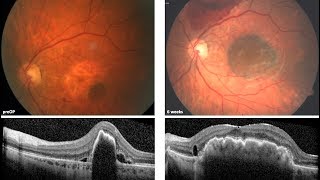 Aderhautpatch zur Behandlung der feuchten AMD mit Pigmentepitheleinriss RIP – Prof Peter Szurman [upl. by Blaine]