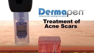 MicroNeedling for Acne Scars  Dermapen® Treatment [upl. by Kruger]