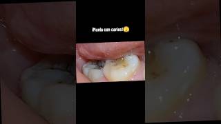 Resina dental 👍 🦷Paciente atendida en Clínica SPA DentaLyL🦷 resinas [upl. by Nirat210]