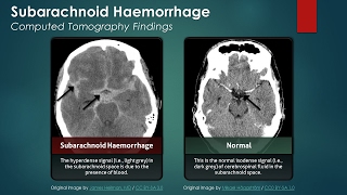 Subarachnoid Hemorrhage SAH Computed Tomography Scan Findings [upl. by Enirehtak605]