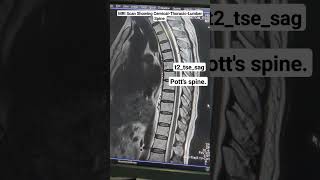 MRI Scan of Spine Showing Potts CervicalThoracicLumber Spine t2tsesag Sequence beginners [upl. by Sacha]