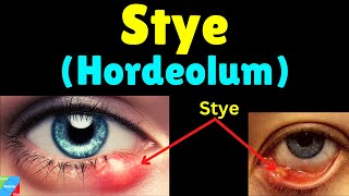 Stye Hordeolum Symptoms Causes Treatment amp Prevention – Sty [upl. by Stargell761]