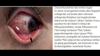 Beidseitige Bindehautentzündung Konjunktivitis im Verlauf einer Affenpockeninfektion [upl. by Hanauq]