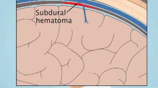 Understanding Subdural Hematoma [upl. by Quentin]