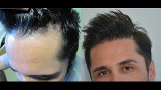 Frontal Hairline Restoration  Hairline implants Dr Doganay [upl. by Eronel]