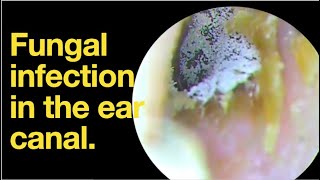 Fungal infection in the ear canal ear wax removal  ear cleaning  ASMR  relaxation  relax [upl. by Alano664]