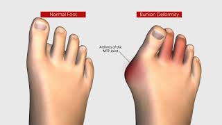 New Bunion Treatment Allows Patients to Walk Within Days [upl. by Nnylorac]