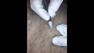 Seborrhoeic keratosis on Chest [upl. by Tudor339]