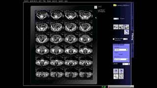 how to make ct scan of Whole Abdomen Filming [upl. by Anelet]