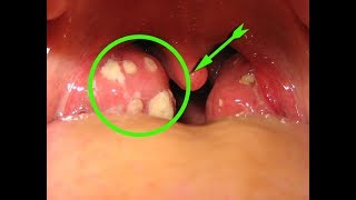 Remove Tonsil Stones With Cotton Swab  tonsils with white dots [upl. by Estelle]