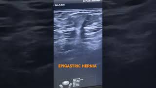 EPIGASTRIC HERNIA usg usgs EPIGASTRIC HERNIA [upl. by Favin]