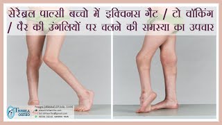 Treatment of Equinus gait toe walking walking on toes in cerebral palsy treatment at Trishla [upl. by Ketty]