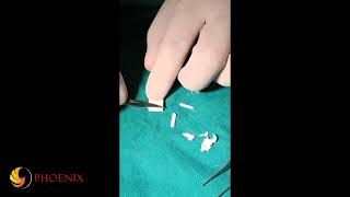 MEGADERM Tip augmentation  Megaderm ចំណិត 1x1cm បង្កើតទម្រងក្បាលច្រមុះ [upl. by Harpp757]