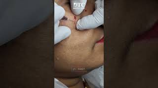 Milia Extraction Procedure  DTC Skin Clinic [upl. by Meg]