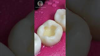 Repairing Dental Caries toothrestoration shorts [upl. by Gnilrits453]