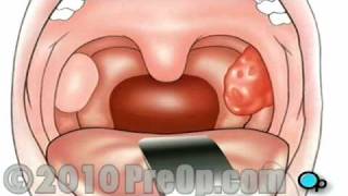 Tonsillectomy Surgery PreOp® Patient Education Feature [upl. by Reivaxe159]