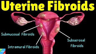 Uterine Fibroids Types Symptoms Causes Diagnosis Treatment and Complications [upl. by Danit]