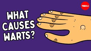 What are warts — and how do you get rid of them  Cella Wright [upl. by Ittak972]