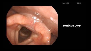 Vocal Cord Movement as Seen By Using Standard Endoscopy Versus Videostroboscopy [upl. by Squires934]