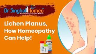 What is Lichen Planus  and Best Homeopathy Treatment for Lichen Planus  Dr Singhal Homeo [upl. by Bourgeois]