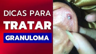 COMO TRATAR GRANULOMA NO PIERCING [upl. by Taka]