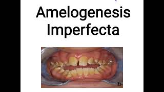 Amelogenesis Imperfecta [upl. by Eentroc]