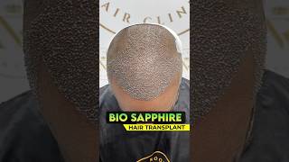 BioSapphire Hair Transplant Result sapphirehairtransplant hairtransplantresults shorts [upl. by Karlen974]